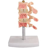 LHMYHHH Modèle d'ostéoporose de Luxe (3 vertèbres) modèle de lésion d'ostéoporose d'anatomie Intelligente, modèle d'os articulaire Spinal et Cervical